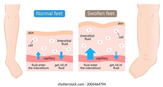 swollen and normal feet with skin diagram. swelling is caused by excess fluid within the tissues of the body. Before after illustration. Health care concept