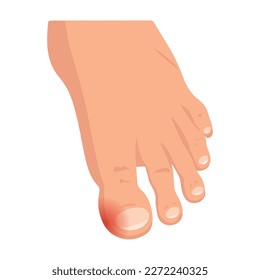 Swollen toe cartoon vector. Person feet with nail disease or infection. Foot with onychomycosis or fungus on fingers.