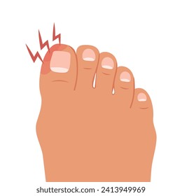 Swollen toe, onychocryptosis. Foot with nail disease or infection. Foot with onychomycosis or nail fungus. Healthcare and medicine. Vector