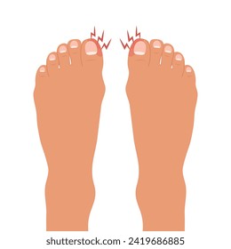 Swollen toe, onychocryptosis. Foot with nail disease or infection. Foot with onychomycosis or nail fungus. Healthcare and medicine. Vector