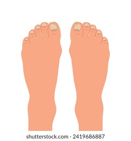 Swollen toe, onychocryptosis. Foot with nail disease or infection. Foot with onychomycosis or nail fungus. Healthcare and medicine. Vector