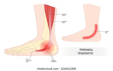 swollen trauma foot bone injury peroneal tendonitis painful ankle torn tendon side sport fall fifth metatarsal flat feet heel motion calf gout high arches weakness stress leg