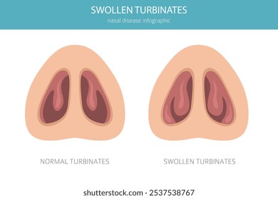 Turbinados inchados. Doenças nasais. Design de infográfico médico. Ilustração vetorial