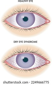 Symbolic medical illustration shows one healthy eye and one affected by dry eye syndrome.