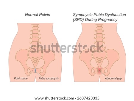 Symphysis Pubis Dysfunction in pregnancy, commonly occurring in the second or third trimester, showing symptoms like pelvic instability and pain.Medical health care vector illustration.