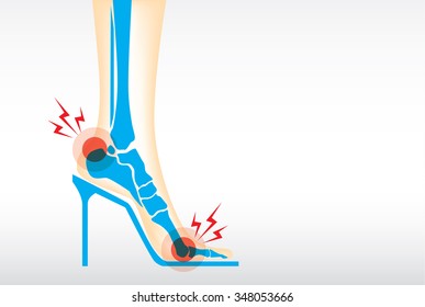 Symptom pain on foot because wearing high heels make heel bone damage and muscles.