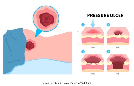 Symptom of paralysis patient and immobility adults with Bedsores pressure ulcer injury skin underlying tissue from lying down or sitting prolonged period time