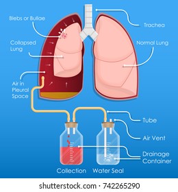 chest tube pneumothorax
