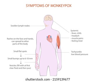 Symptome einer Infektion mit Monkeypox, Vektorgrafik, Abbildung. Infektion in Afrika, Europa.