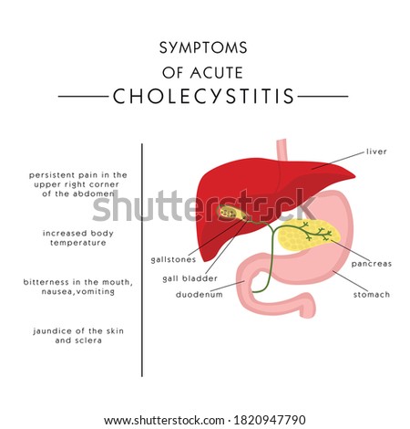 symptoms of acute cholecystitis, gallstones. Vector flat illustration
