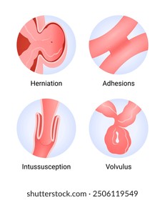 Síntomas y causas de la obstrucción intestinal