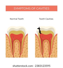 Symptoms of cavities in humans, comparison of normal teeth and cavities