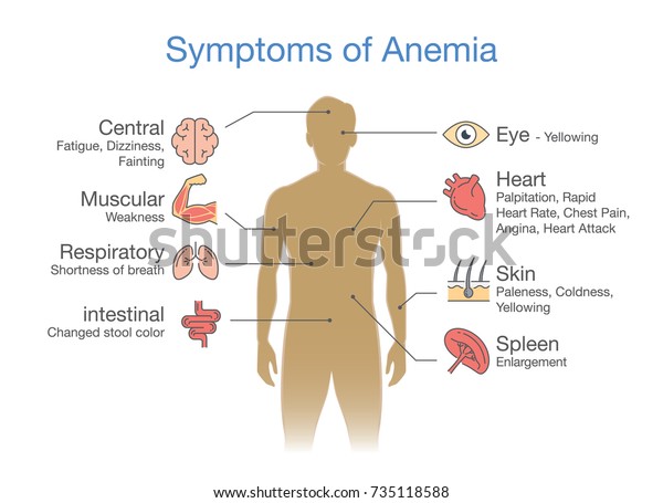 Symptoms Common Many Types Anemia Illustration 库存矢量图（免版税）735118588 Shutterstock 6226