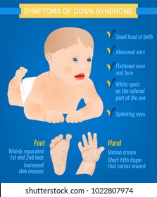 Symptoms of down syndrome poster. Abnormal ears, short hands, flattened face and nose, heart disease, big toes widely spaced. Vector illustration in blue and yellow colors with little boy image.