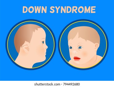 Symptoms of down syndrome poster. Abnormal ears, short hands, flattened face and nose, heart disease, big toes widely spaced. Vector illustration in blue and beige colors with little boy image.