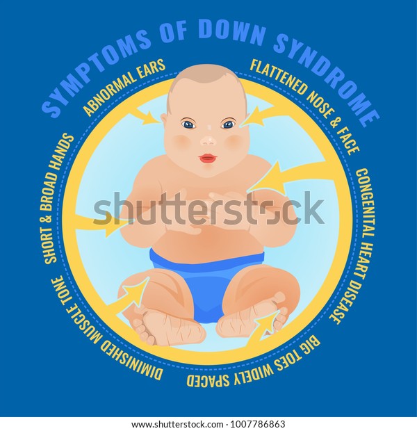 Symptoms Down Syndrome Poster Abnormal Ears Stock Vector Royalty Free 1007786863 4612