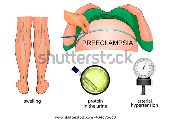 the symptoms of\
eclampsia during pregnancy: swelling of the feet, hypertension and\
protein in the urine\

