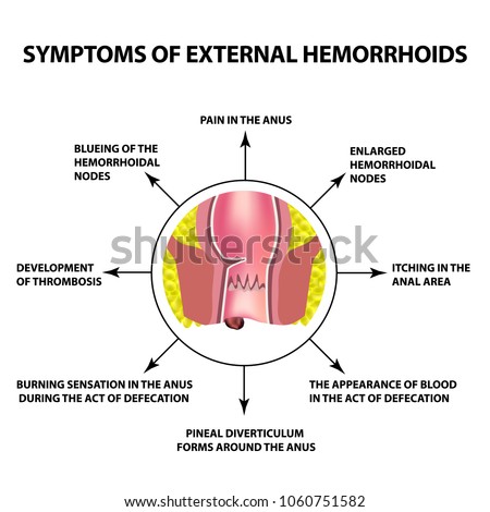 Symptoms of external hemorrhoids. The hemorrhoidal node in the rectum, anus. Infographics. Vector illustration on isolated background.