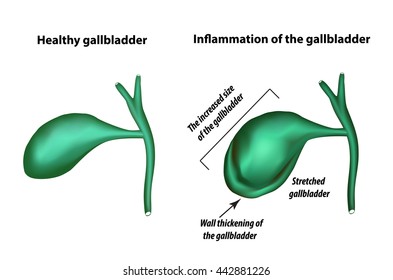 Symptoms Of Gallbladder Inflammation. Cholecystitis. Thickening Of The Gallbladder Wall. Increased Gall Bladder. Infographics. Vector Illustration On Isolated Background.