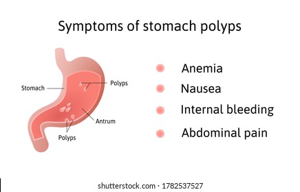 Symptoms of gastric polyps. pedunculated and flat-based polyp. Antrum. Anemia, nausea. Medical vector illustration marked with lines.