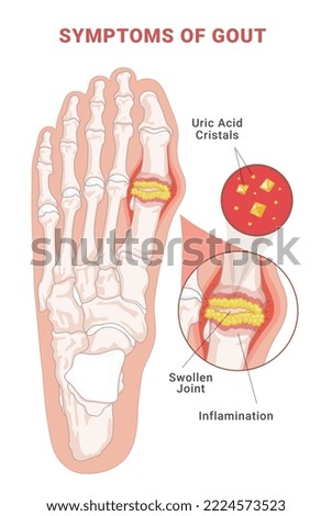 Symptoms of gout infographic scheme vector flat illustration. Human foot with crystallization of uric acid joint with inflammatory arthritis medical educational poster. Orthopedic disease injury pain