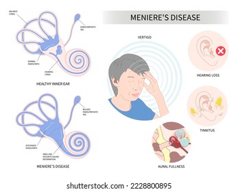 Symptome einer Vertigo-Krankheit mit Ohrenschmerzen, die Kopfschmerzen und Cochlea Anatomie in der Medizin verursachen