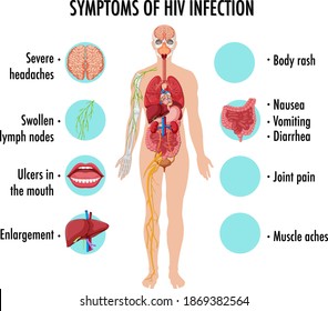 Symptoms of HIV infection infographic illustration