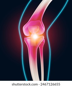 Symptoms of human knee joint injury and inflammation which causes suffering from pain Tendon and arthritic problems. health care and medicine. Realistic vector illustration.