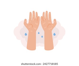 symptoms of hyperhidrosis. illustration of very sweaty palms. hands produce excessive sweat. health problems. cartoon or flat illustration design. graphic elements. vector