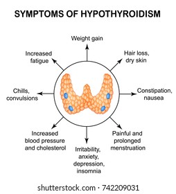 Síntomas de hipotiroidismo. Tiroides. Infografía. Ilustración vectorial en fondo aislado.