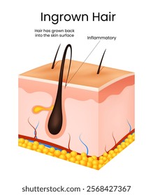 Symptoms of the Ingrown Hair