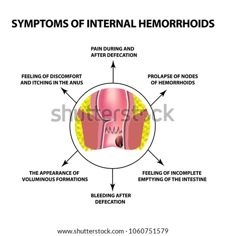 Symptoms of internal hemorrhoids. The hemorrhoidal node in the rectum, anus. Infographics. Vector illustration on isolated background.