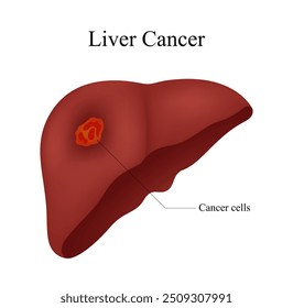 Symptoms of Liver Cancer Diagnosis