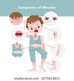 Symptoms of Measles Illustration vector