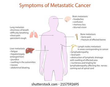 Symptoms Metastatic Cancer Vector Medical Diagram Stock Vector (Royalty ...