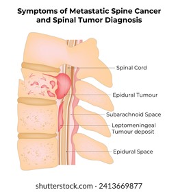 Symptoms of Metastatic Spine Cancer and Spinal Tumor Diagnosis Science Design Vector Illustration