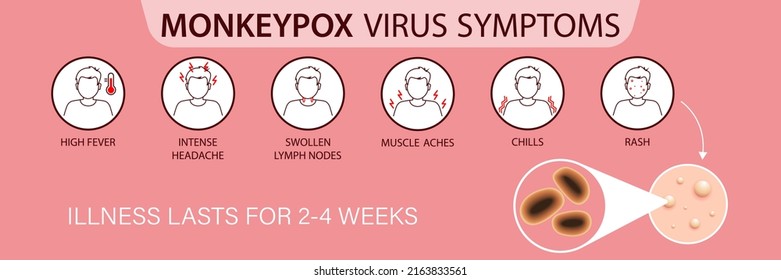 Symptoms of the monkey pox virus.  Monkey pox is spreading. This causes skin infections. Infographic of symptoms of the monkey pox virus