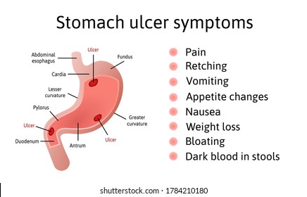 Peptic ulcer symptoms