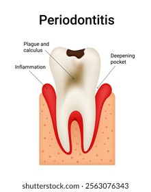 Symptoms of Periodontitis inflammation of gums and bone supporting the teeth