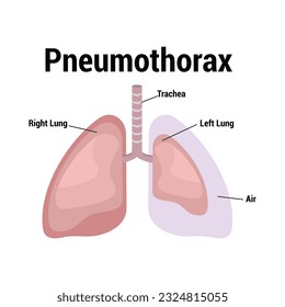 symptoms of pneumothorax lung vector
