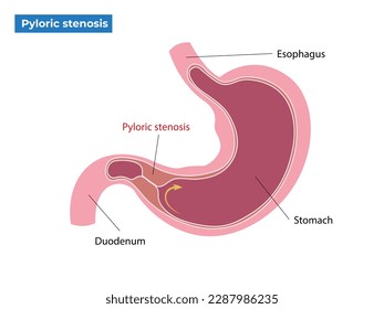 Symptoms of pyloric stenosis vector illustration