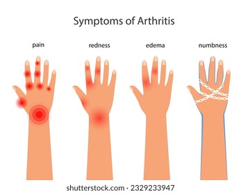 Symptoms of Rheumatoid arthritis, redness, edema, numbness. Pain in the hands with an autoimmune disease vector poster with autoimmune disease illustration