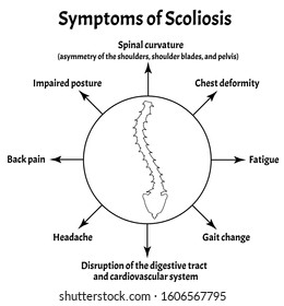 Symptoms of Scoliosis. Spinal curvature, kyphosis, lordosis of the neck, scoliosis, arthrosis. Improper posture and stoop. Infographics. Vector illustration on isolated background.