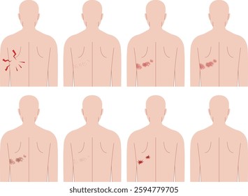 Symptoms of shingles. Human upper body seen from the back.