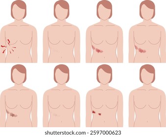 Symptoms of shingles. A woman's upper body seen from the front.