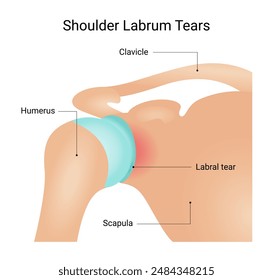 Symptoms of Shoulder Labrum Tear