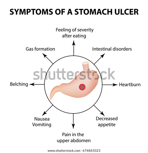 Symptoms Stomach Ulcer Infographics Vector Illustration Stock Vector ...