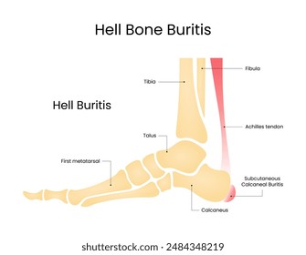 Symptoms of Subcutaneous Calcaneal Bursitis