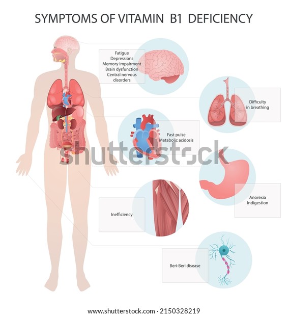 Symptoms Vitamin B1 Deficiency Medical Vector Vetor Stock Livre De   Symptoms Vitamin B1 Deficiency Medical 600w 2150328219 