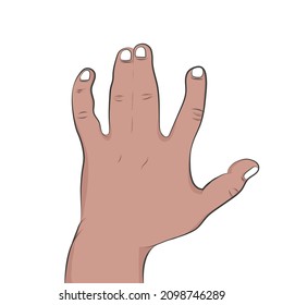 Syndactyly, Is The Connection Of 2 Or More Fingers Or Toes.